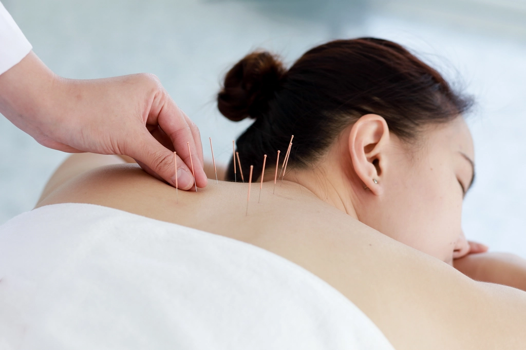 Acupuncture